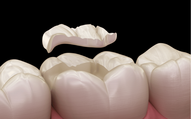 Are Temporary Tooth Filling Kits Safe