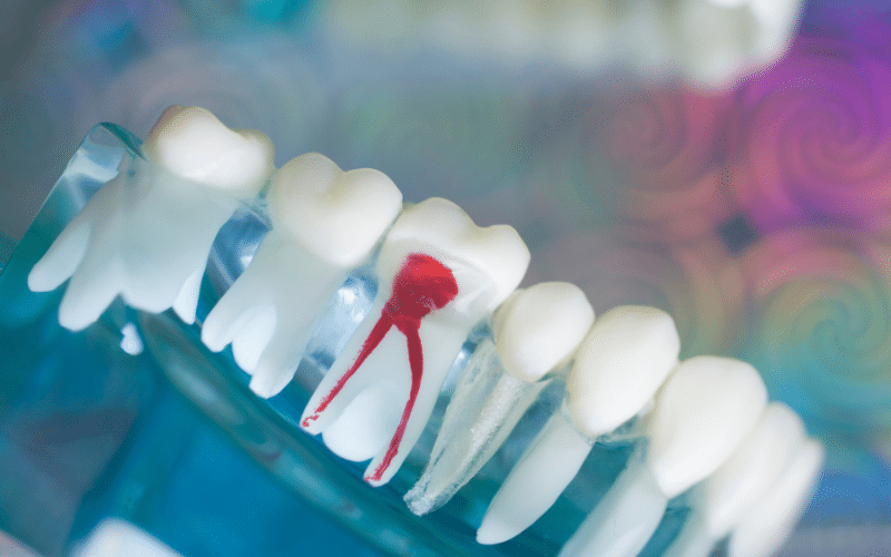 understanding the long-term benefits of root canal therapy
