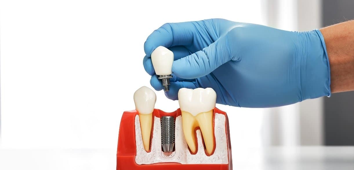 how dental implants prevent bone loss restore jaw health and enhance your smile
