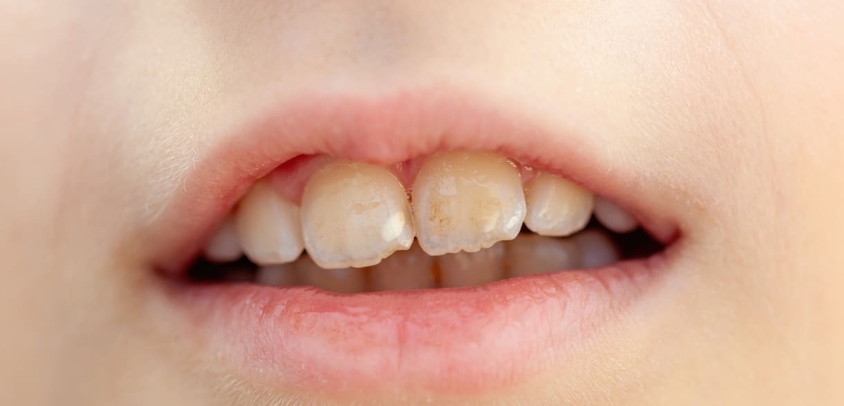 the black spots on front teeth of children